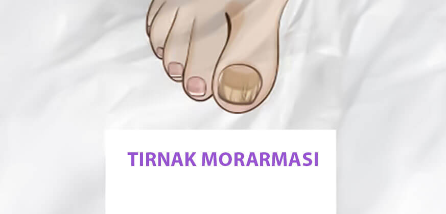 Ayak Tırnakları Neden Morarır? Belirtiler, Nedenler ve Tedavi Seçenekleri